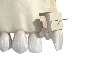 digital illustration of bone being grafted above a missing front tooth